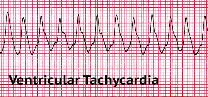 Ansia e tachicardia-elettrocardiogramma Ansia e tachicardia-elettrocardiogramma