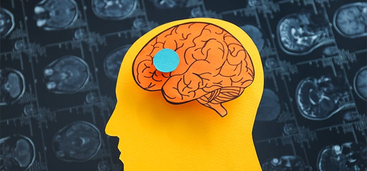 Sequestro emozionale - immagine cervello umano